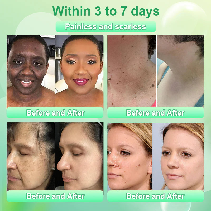 Purifying Exfoliating Gel for Acanthosis Nigricans, Exfoliation, Dark Spots, Skin Tags, and Eczema